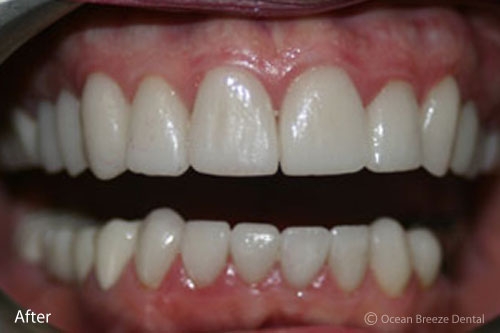 closeup image of straight, white teeth with veneers