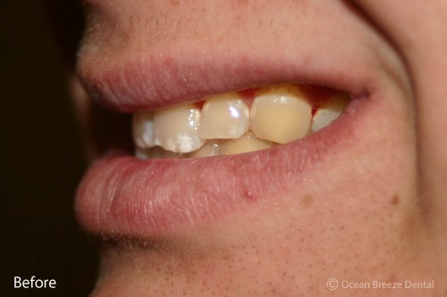 closeup profile photo of patient before treatment, crooked and yellow teeth