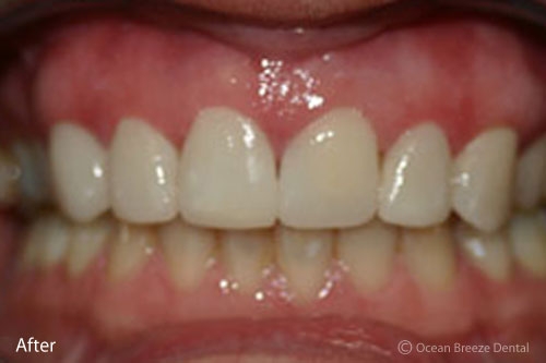 closeup photo patient's straight, white teeth after treatment