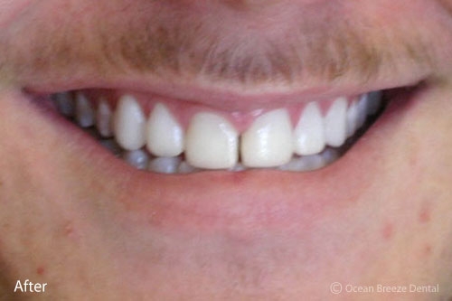 closeup of young male patient's smile after treatment