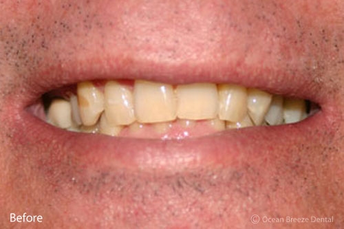 closeup of male patient, crowded and stained teeth before treatment
