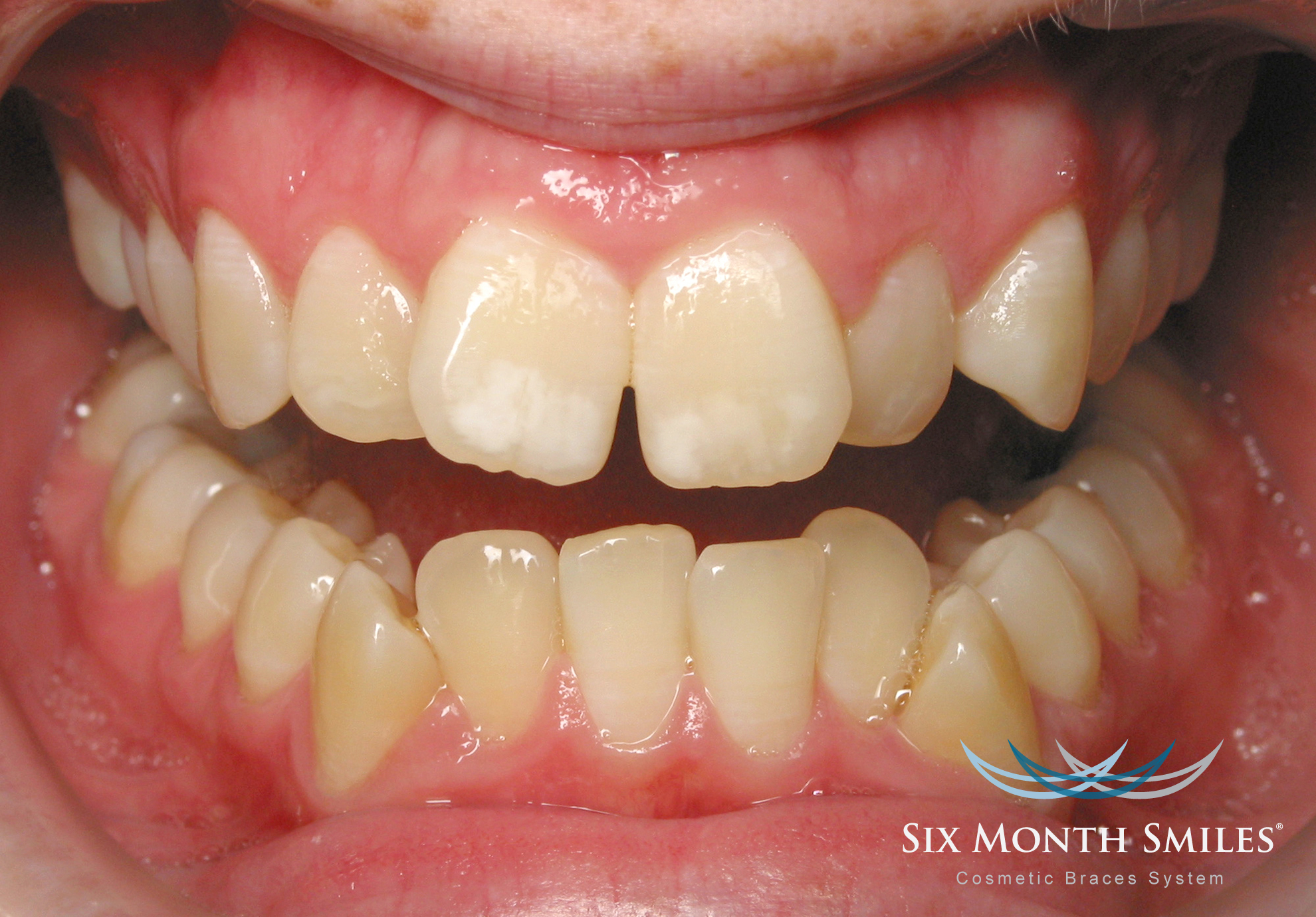 Before photo of patient teeth Six Month Smiles cosmetic adult braces orthodontic