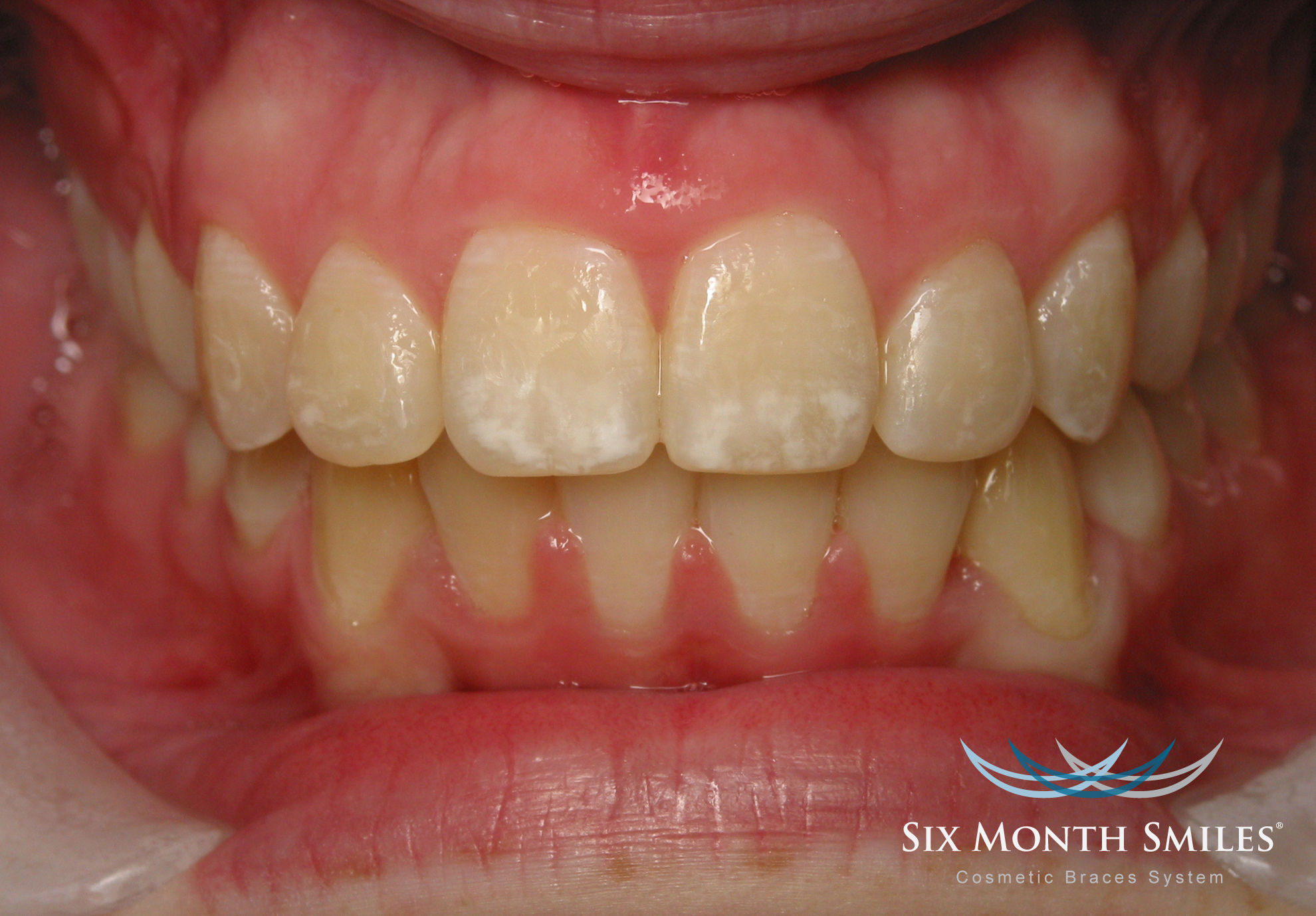 photo of patient teeth after Six Month Smiles cosmetic adult braces orthodontic