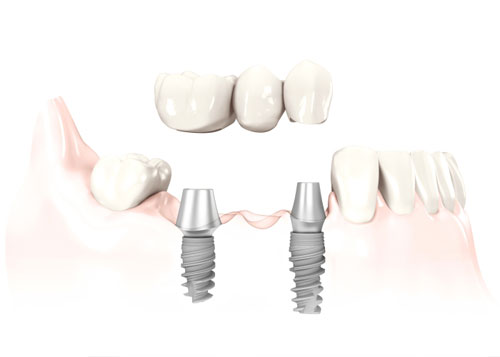 implant bridge replacing 3 missing teeth