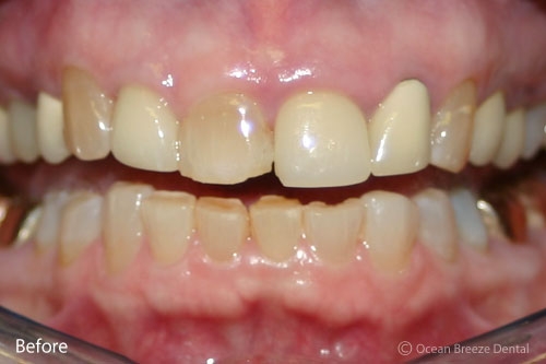 closeup photo of crowded, uneven teeth before treatment