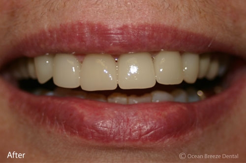 closeup of female patient's smile after procedure