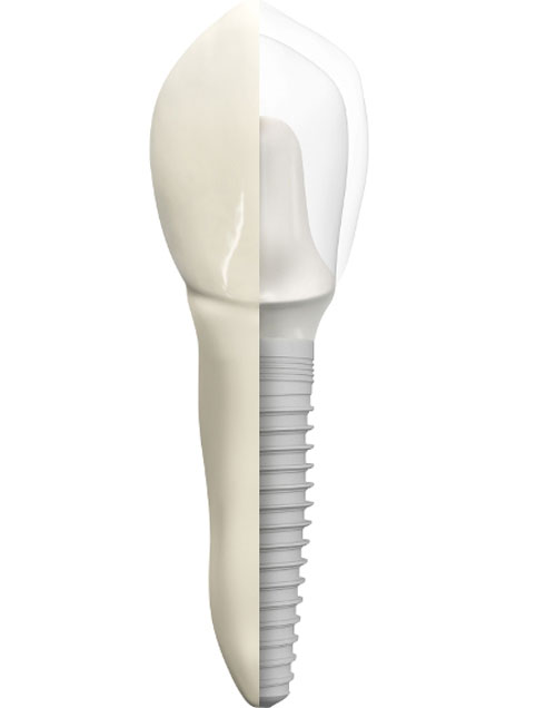 cross section image of a tooth used in dental implant procedure