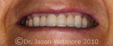 After image for dental implant restoration 
