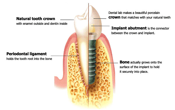 cross section diagram of tooth implant