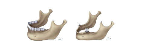 diagram of bone resorption after loss of teeth, before implant bridge