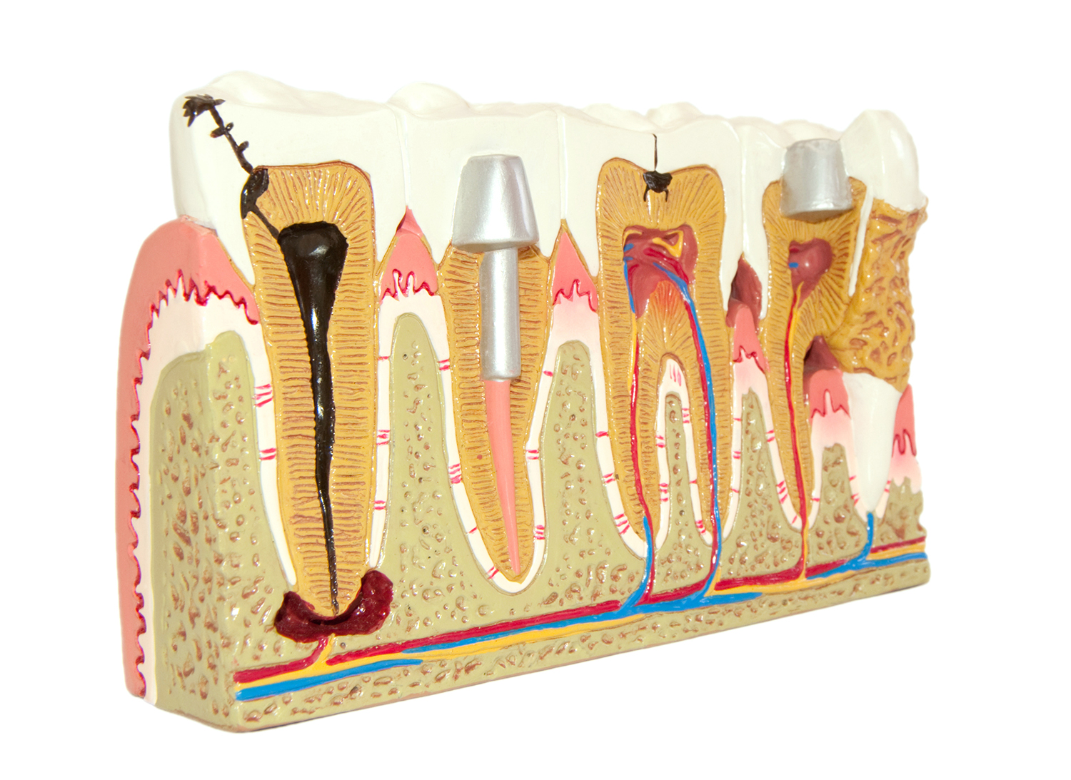 cross section diagram of root canal procedure