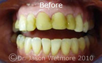 photo of patient teeth Before Crowns
