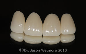 photo of porcelain crowns