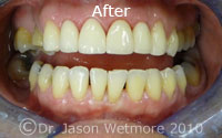 photo of patient teeth with new crowns
