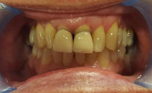 male patient closeup before photo stained teeth and crowns
